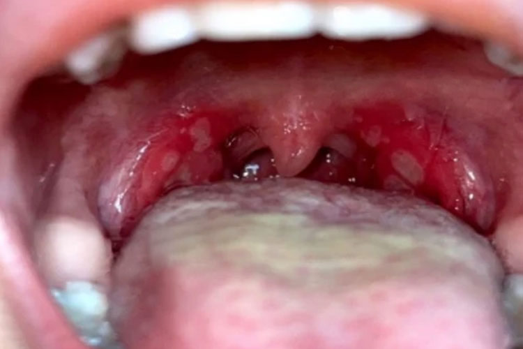 儿童疱疹性咽峡炎溃疡期图
