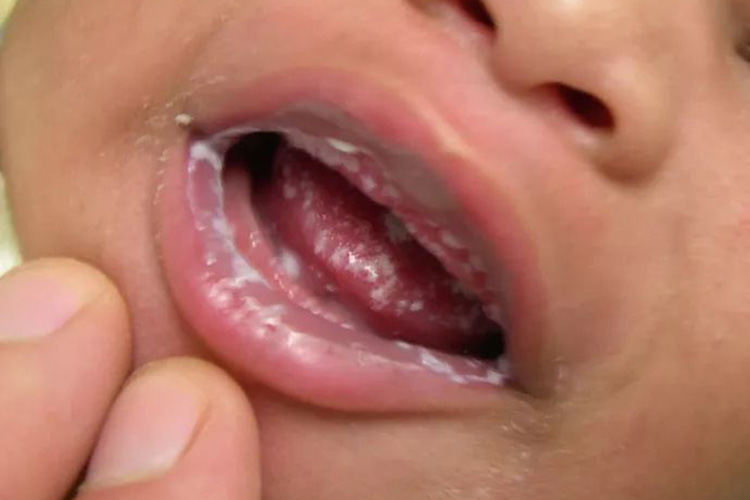 舌头霉菌感染图