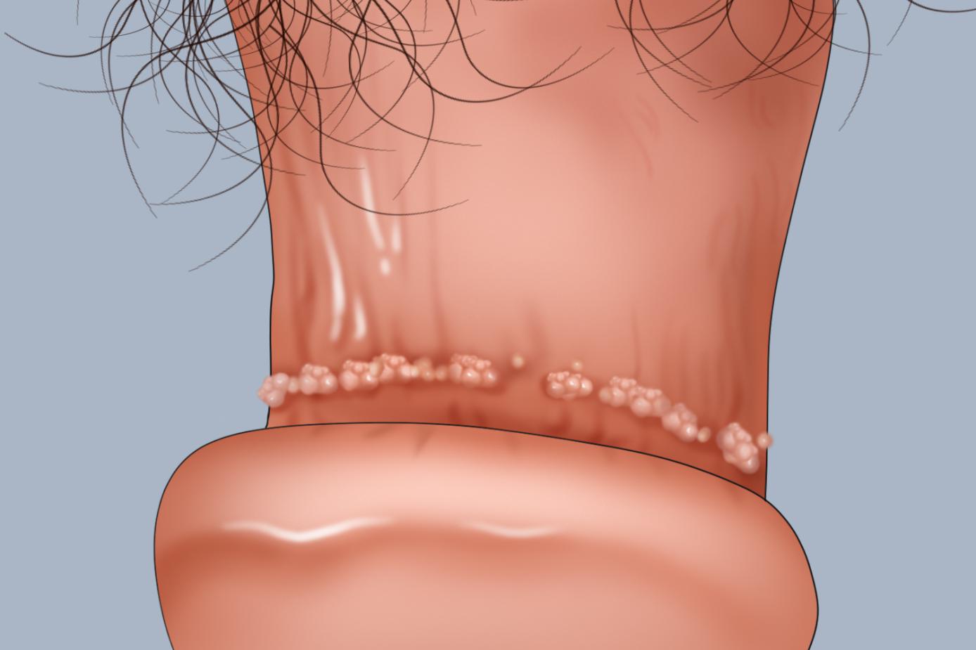尖锐湿疣冠状沟肉芽图 尖锐湿疣冠状沟肉芽图