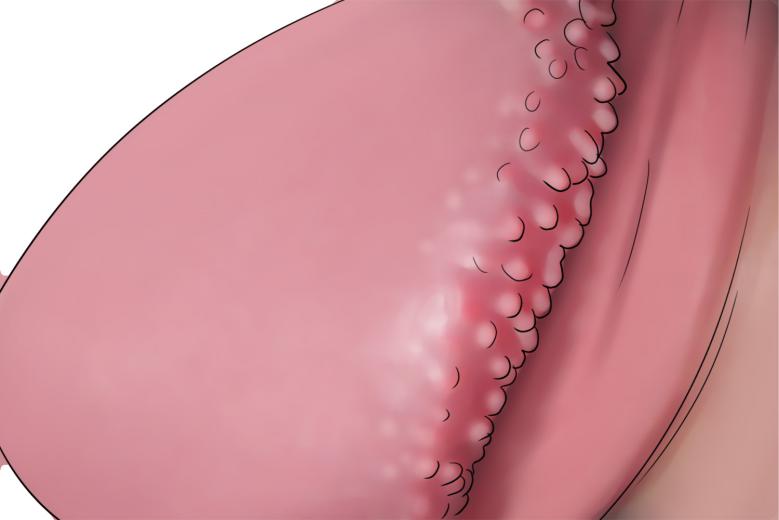 阴茎珍珠状丘疹冠状沟肉芽图 阴茎珍珠状丘疹冠状沟肉芽图