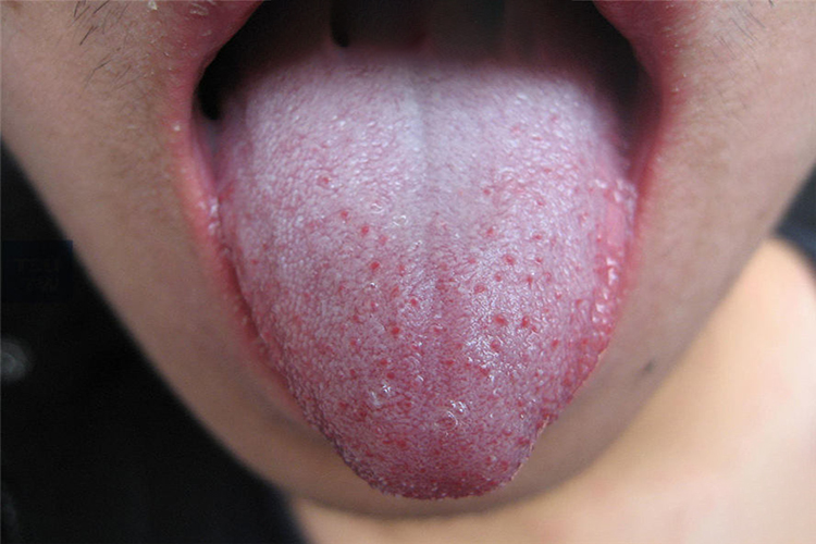 猩红热舌乳头增生图