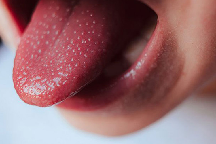 川崎病舌乳头增生图