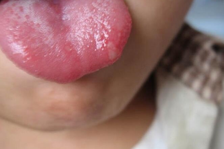 原发性疱疹性口炎图