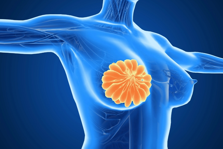 乳腺结节酒窝征图 乳腺结节酒窝征图