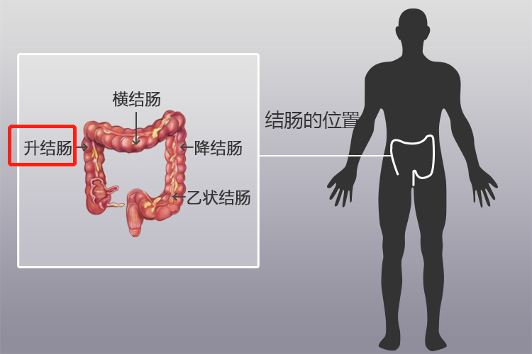 升结肠炎疼痛位置图