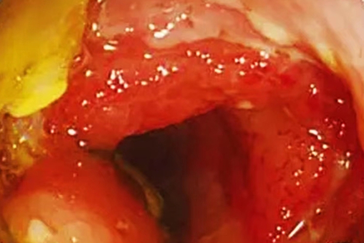 升结肠溃疡性结肠炎图