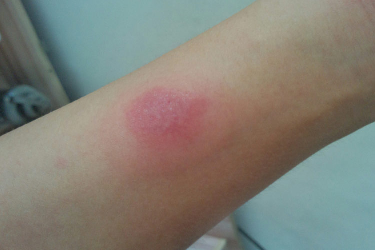 头孢过敏症状图 头孢过敏症状图