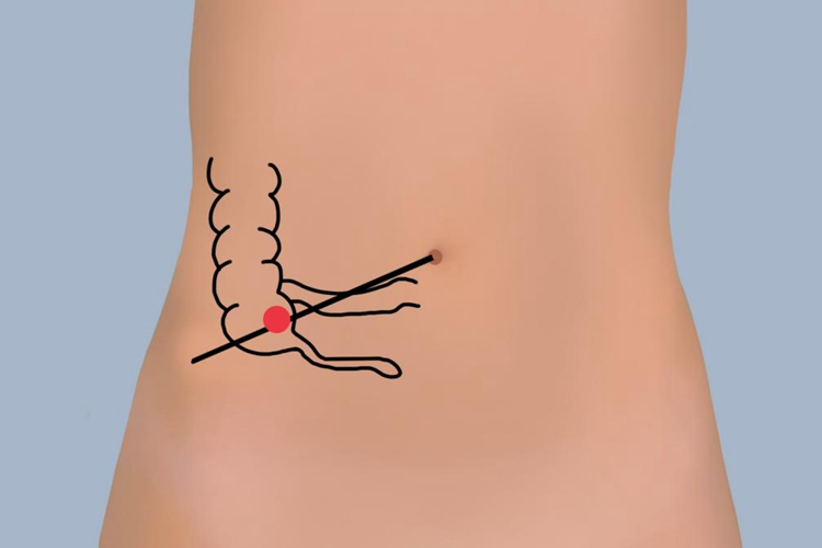 阑尾体表投影图