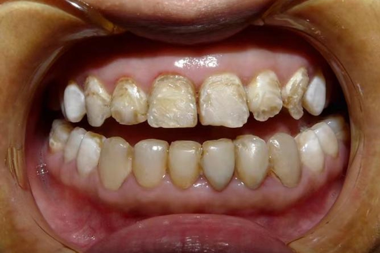 吃什么药会导致牙齿腐蚀 1655790802403645.png