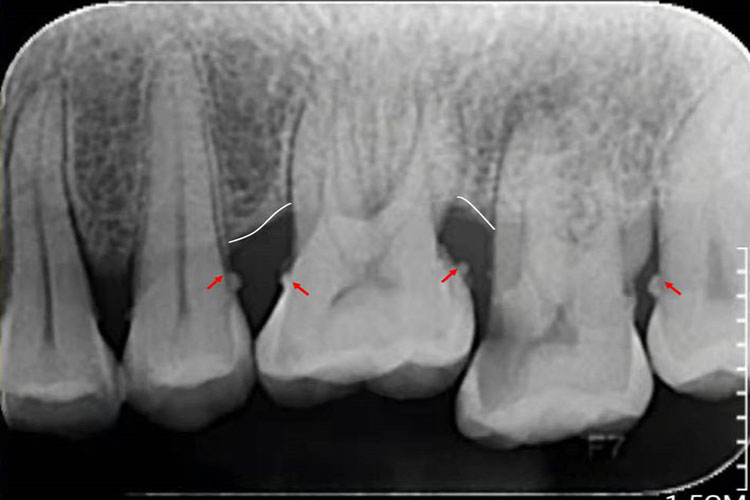 龈下牙结石X线影像图